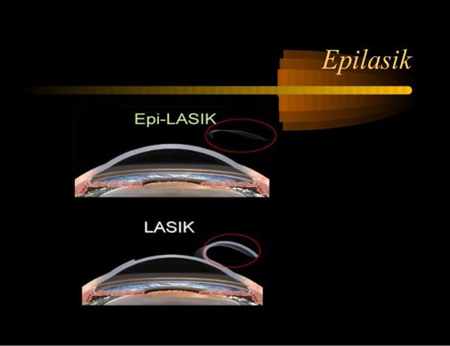 Hướng dẫn đầy đủ về Phẫu thuật Epi-LASIK