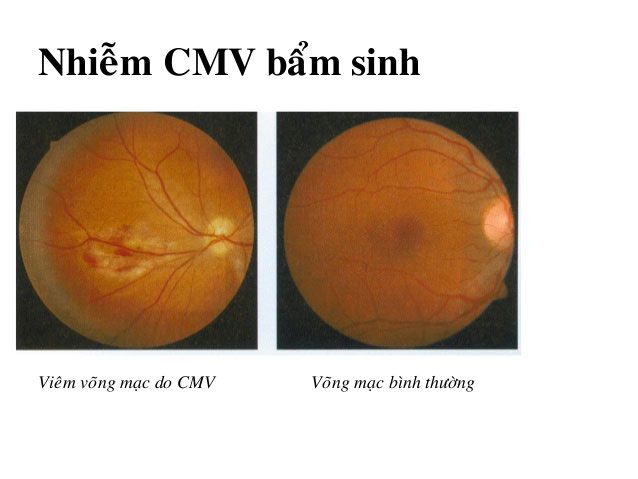 Giảm nguy cơ mắc các bệnh về mắt và duy trì đôi mắt khỏe mạnh