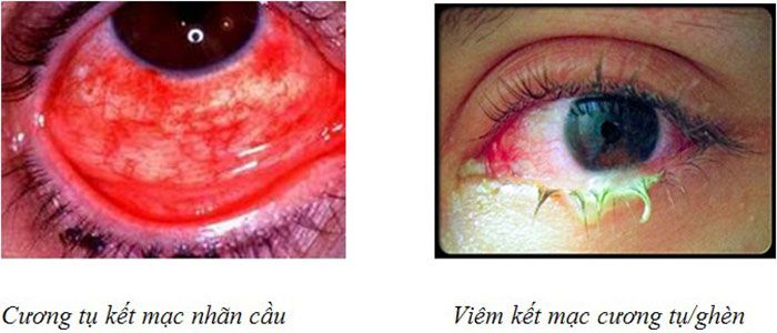 Bệnh viêm kết mạc mắt - bệnh đau mắt đỏ