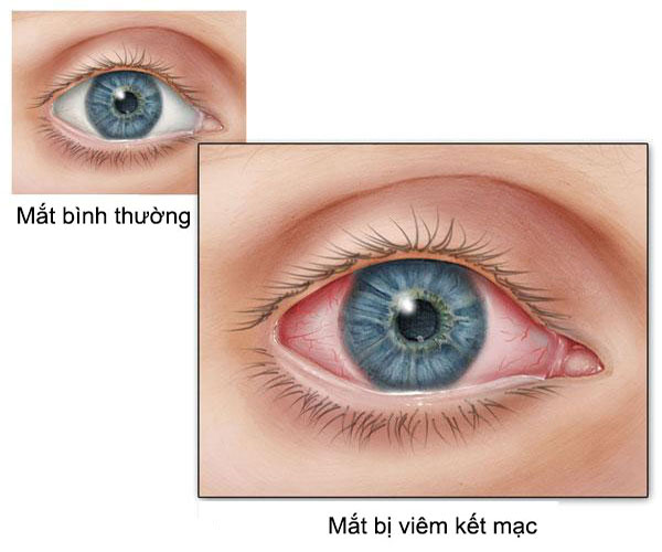 Bệnh viêm kết mạc mắt - bệnh đau mắt đỏ