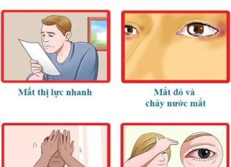Bệnh tăng nhãn áp - cườm nước (Glaucoma)