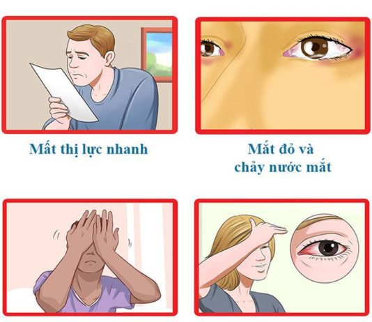 Bệnh tăng nhãn áp - cườm nước (Glaucoma)