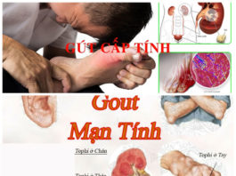 Chẩn đoán bệnh gút và điều trị bệnh gút tại Việt Nam