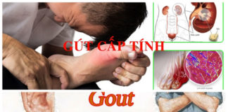 Chẩn đoán bệnh gút và điều trị bệnh gút tại Việt Nam