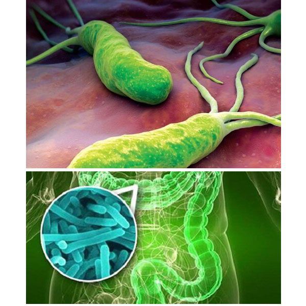 Vi khuẩn H. Pylori gây ra bệnh tiêu chảy