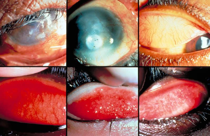 Bệnh đau mắt hột cách phòng tránh và điều trị