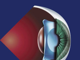 Phẫu thuật Phakic ICL kinh nghiệm mổ mắt dành cho người cận thị nặng giác mạc mỏng